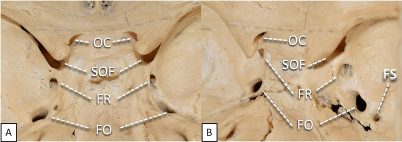 File:Cranial nerve foramina within middle cranial fossa.png