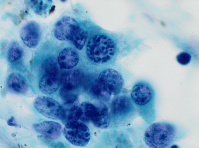 File:Cytology of pancreatic well-differentiated neuroendocrine tumor with salt-and-pepper chromatin, Pap stain.jpg