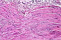 Eosinophilic cystitis, high mag.2