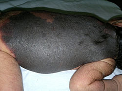 Giant congenital melanocytic nevus in newborn
