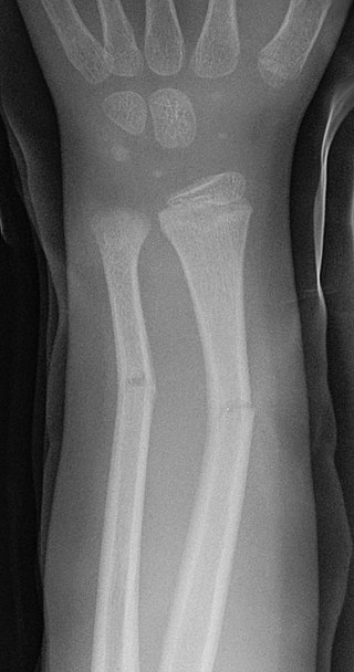 <span class="mw-page-title-main">Greenstick fracture</span> Medical condition