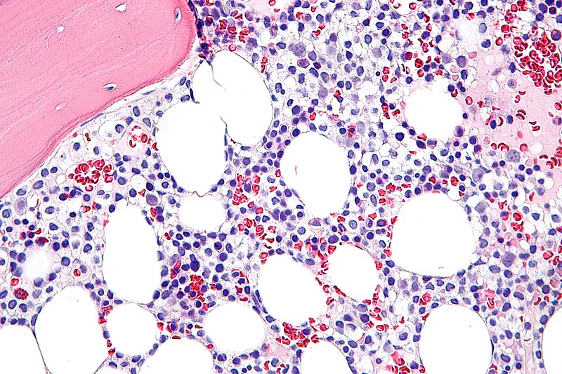 File:Hairy cell leukemia - very high mag.jpg