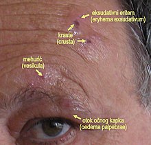 Zoster ophthalmicus. Labels in Serbian, from top: exudative erythema, scabs, blister, eyelid swelling Herpes zoster ophthalmicus.2.jpg