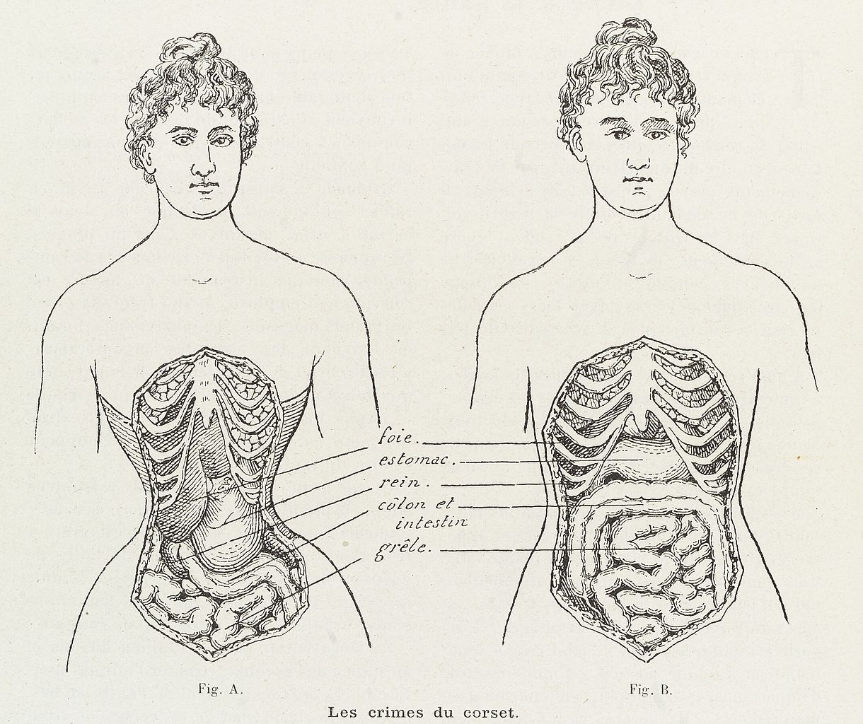 File Illustrations To Denounce The Crimes Of The Corset Wellcome L0038404 Jpg Wikimedia Commons