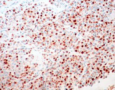 Invasive Lobular Carcinoma of the Breast, E-Cadherin Immunostain with Aberrant Pattern (13991322719).jpg