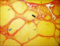 Vignette pour Fibrose hépatique