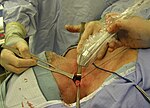 Thumbnail for Lymphadenectomy