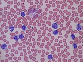 Lymphocytosis.JPG