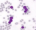 Thumbnail for Minimally differentiated acute myeloblastic leukemia