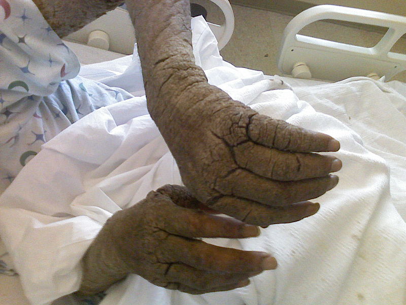 File:Norwegian Scabies in Homeless AIDS Patient.jpg