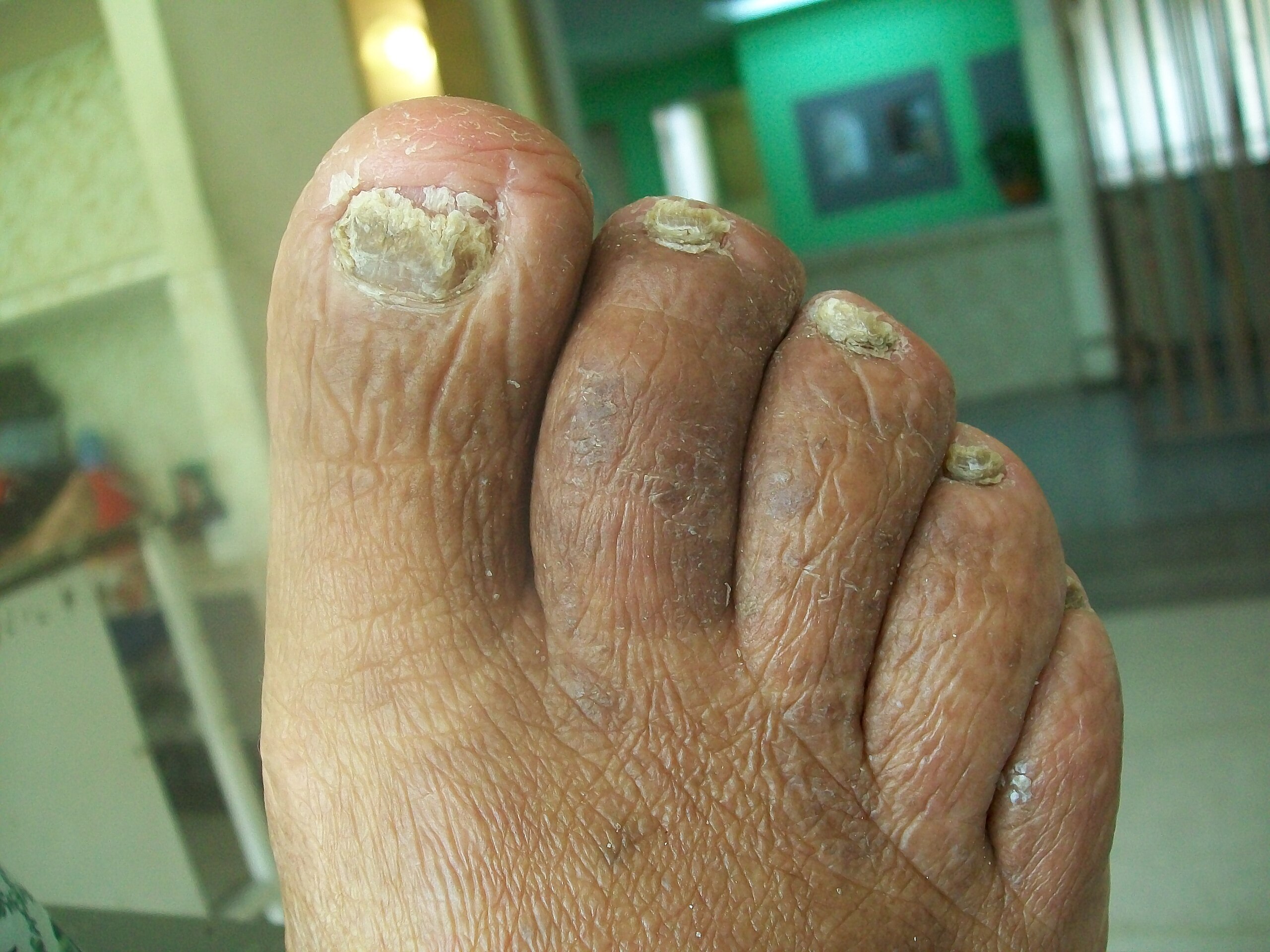 Onychomycosis - Wikipedia