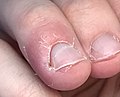 Desquamation of skin on the finger, caused by the popping of an acute paronychia