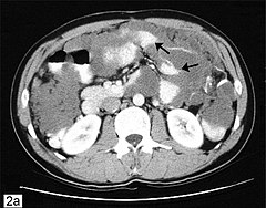 Pseudomyxoma.jpg