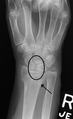 Scapholunate ligament disruption associated with a Colles' fracture