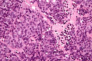 Sinonasal undifferentiated carcinoma - very high mag.jpg