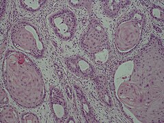 Adenoid squamous-cell carcinoma