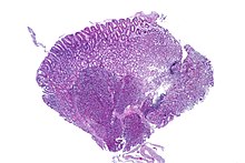 Stomach with pancreatic heterotopia, low mag.2.jpg