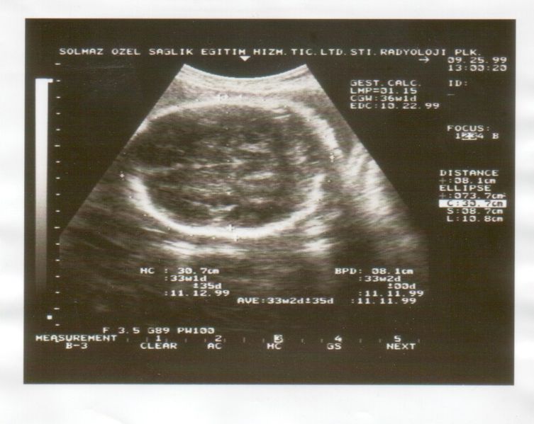 File:Ultrasound Scan ND 048.jpg