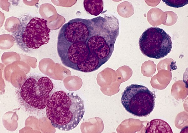 A bone marrow smear from a case of erythroleukemia. The large cell in the top center is an abnormal erythroblast: it is multinucleated, with megalobla