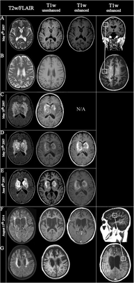 Acute hemorrhagic Leukoencephalitis in a patient with Multiple sclerosis. Acute hemorrhagic Leukoencephalitis in a patient with Multiple sclerosis (MRI).png