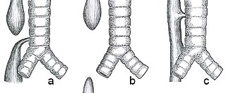 Esophageal atresia Congenital discontinuity of the oesophagus