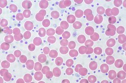 Essential Thrombocythemia, Peripheral Blood (10189570483).jpg