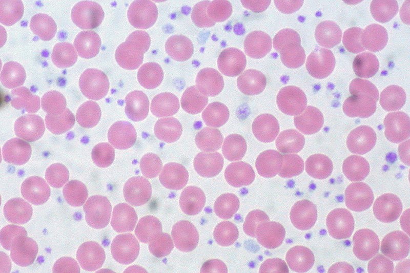 File:Essential Thrombocythemia, Peripheral Blood (10189570483).jpg