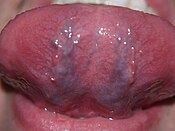 The underside of a human tongue, showing its rich blood supply. Facies inferior linguae.JPG