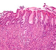 Gastritis helicobacter - intermed mag.jpg