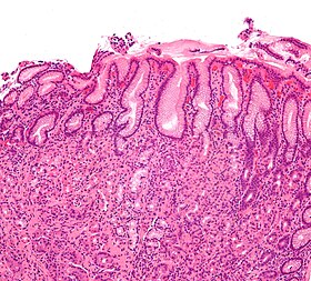 Gastritis helicobacter - intermed mag.jpg