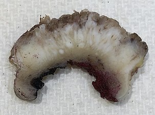 Gross slice of a squamous cell carcinoma of the skin.
