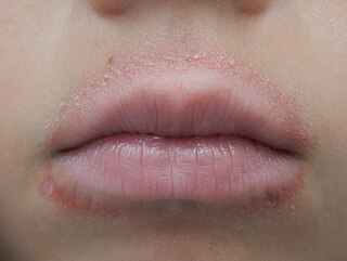 Lip lickers dermatitis