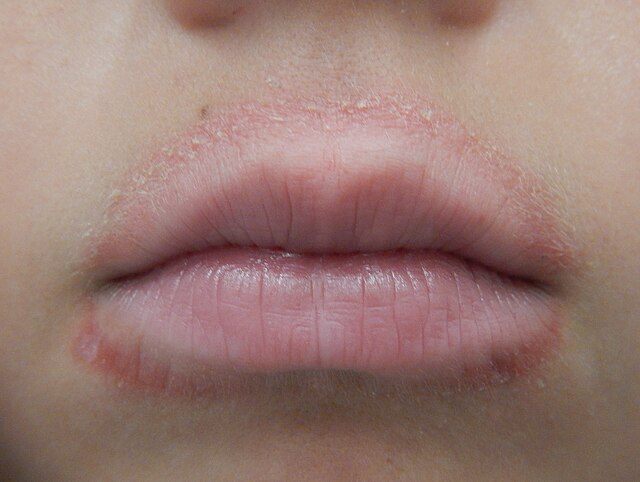 Lip licker's dermatitis - Wikipedia