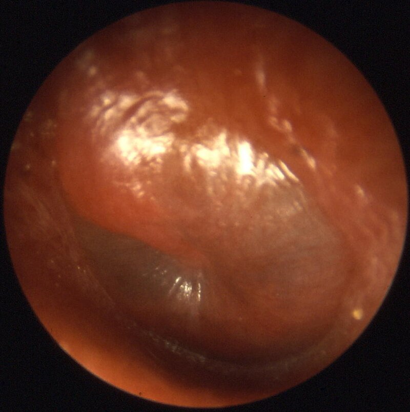 normal tympanic membrane vs bulging