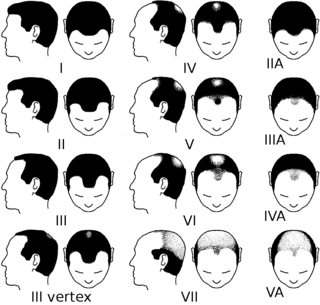 <span class="mw-page-title-main">Hamilton–Norwood scale</span> Scale used to classify male pattern baldness