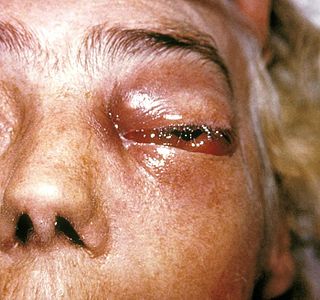 Periorbital fungal infection known as mucormycosis, or phycomycosis PHIL 2831 lores.jpg