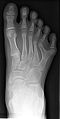 Röntgenfoto van voet met 6 tenen