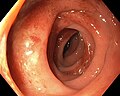 Thumbnail for Segmental colitis associated with diverticulosis