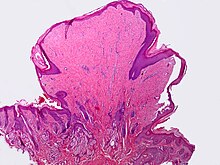 Micrograph of fibroepithelial polyp SkinTumors-P9250819.jpg