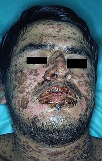 <span class="mw-page-title-main">Stevens–Johnson syndrome</span> Skin disease