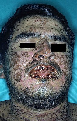 Stevens-johnson-syndrome.jpg