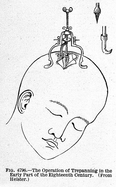 File:Trephining, from Buck "Reference handbook...", 1904 Wellcome L0005709.jpg