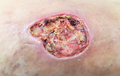 Úlcera varicosa (RPS 24-08-2020) en pierna con insuficiencia venosa crónica.png