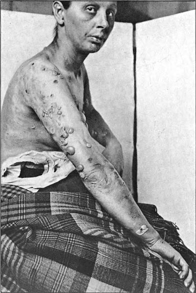 File:An introduction to dermatology (1905) Hydroa gravidarum.jpg