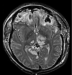 إصابة دماغية مع انفتاق (صورة رنين مغناطيسي)