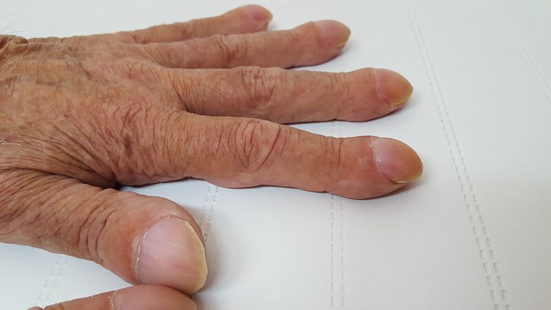 File:Clubbing fingers 2.jpg