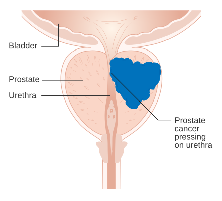 Diagram of prostate tumour pressing on urethra