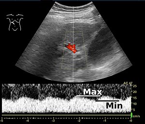 paraumbilical vein ultrasound