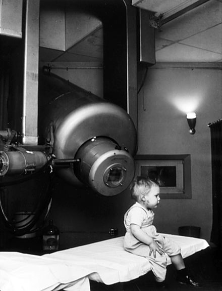 Historical image showing Gordon Isaacs, the first patient treated for retinoblastoma with linear accelerator radiation therapy (in this case an electron beam), in 1957, in the U.S. Other patients had been treated by linac for other diseases since 1953 in the UK. Gordon's right eye was removed on January 11, 1957 because cancer had spread there. His left eye, however, had only a localized tumor that prompted Henry Kaplan to treat it with the electron beam.