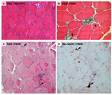 Microscopic cross-sectional views of FSHD-affected muscle fibers. Visible is inflammation and fibrosis, as well as muscle fiber shape change, death, and regeneration. Facioscapulohumeral muscular dystrophy histology.jpg